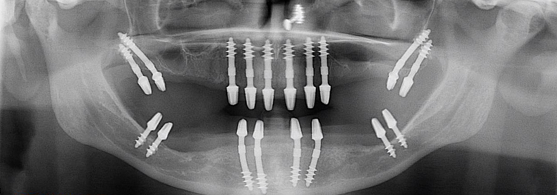 Which is the best dental implant?