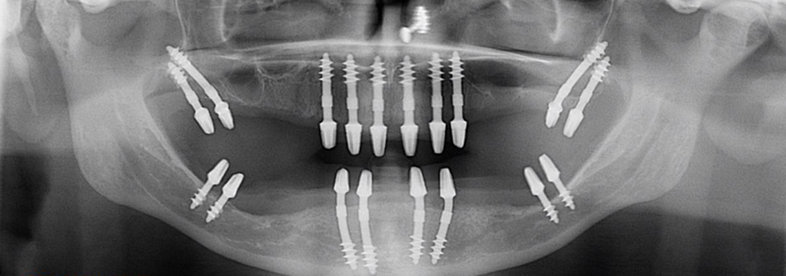 Read more about the article Which is the Best Dental Implant?
