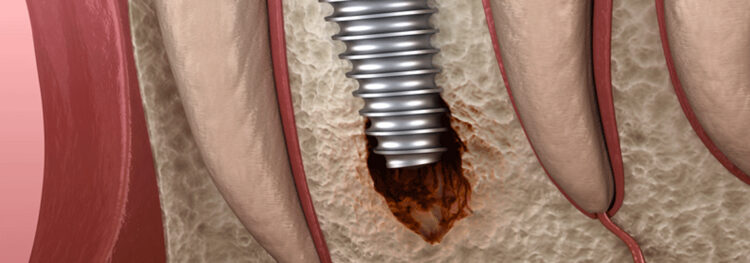 How Can Smoking Lead to Dental Implant Failure?