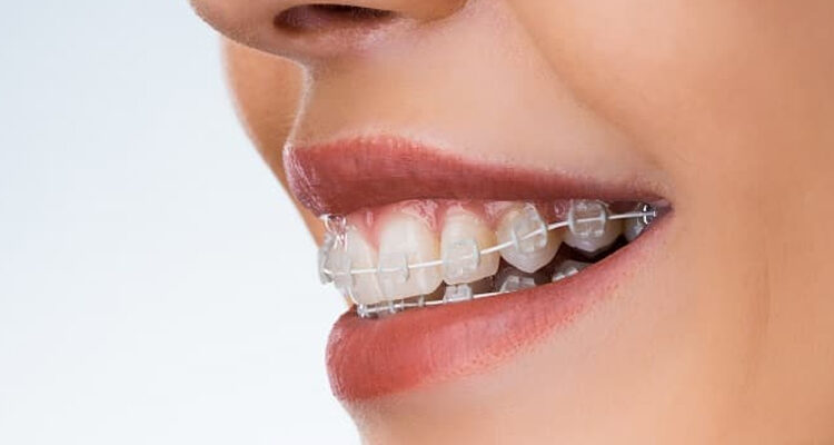 Overbite