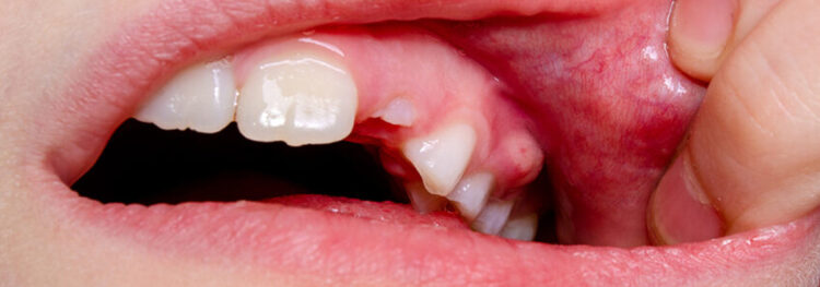 Tooth Abscess & Its Causes