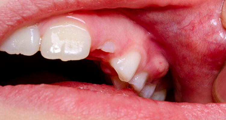 Tooth Abscess & Its Causes