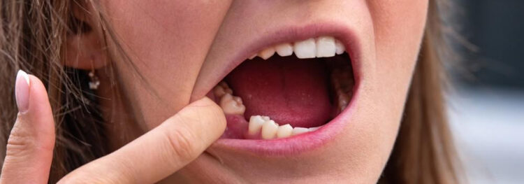 What Can Happen If I Don't Replace My Lost Teeth?