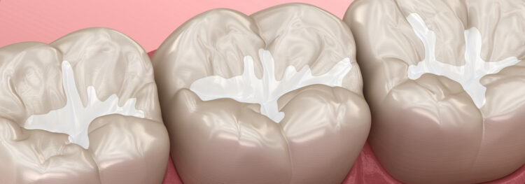 How Dental Sealants Protect Your Teeth?