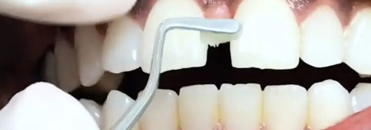 Filling in the Gaps to Restore Your Smile