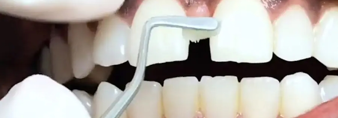 Read more about the article Filling in the Gaps to Restore Your Smile