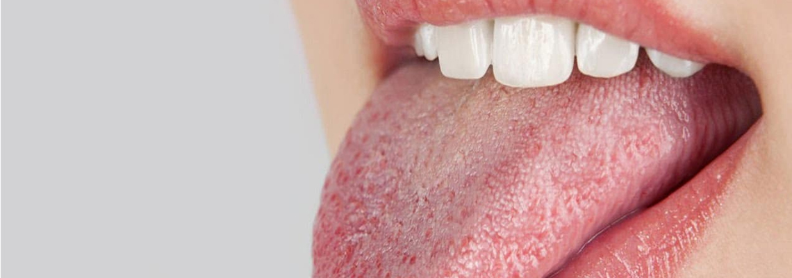 Read more about the article Managing Dry Mouth for a Healthy Smile