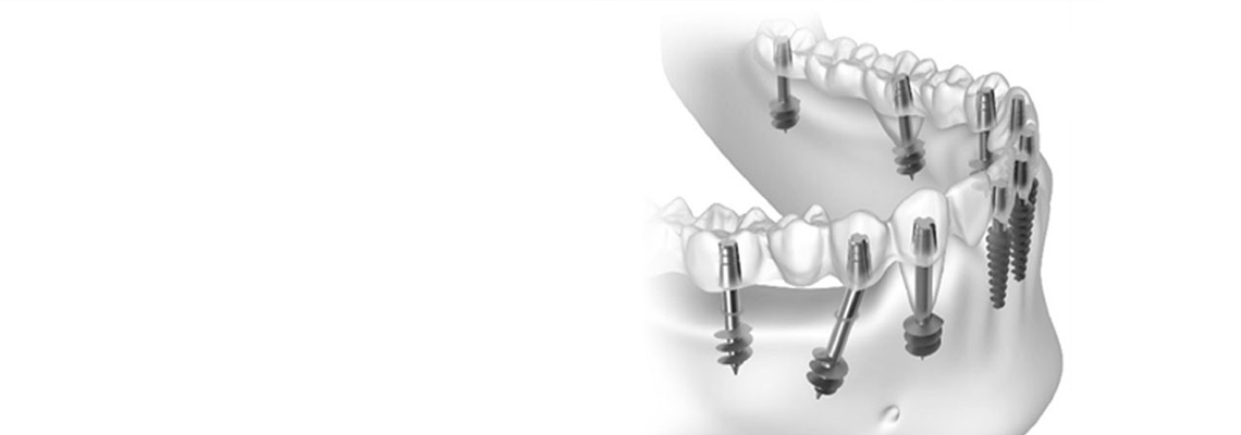 Basal Implants: A Minimally Invasive Alternative to Bone Grafts