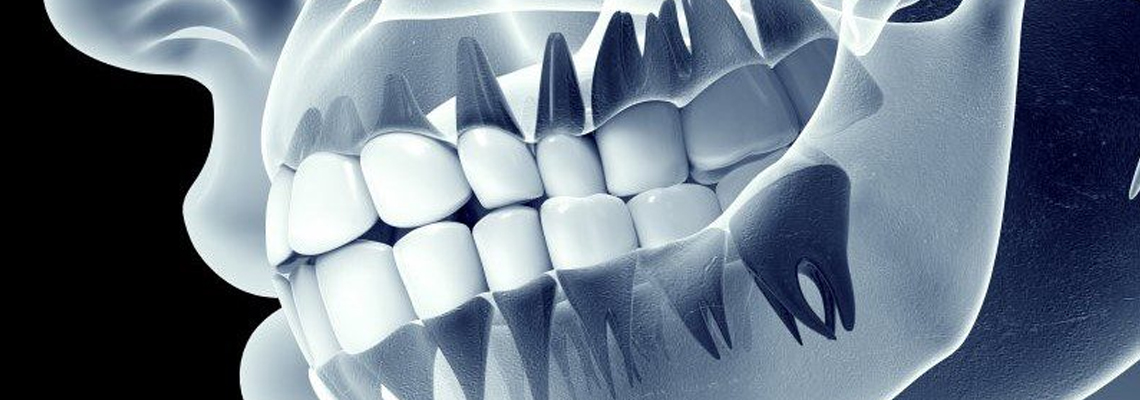 How Dental Implants Prevent Bone Loss?