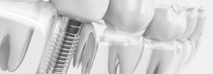 Immediate Vs. Delayed Loading Of Dental Implants