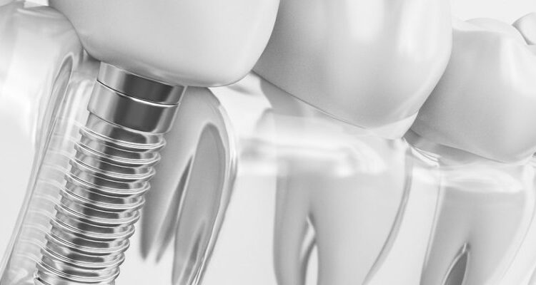 Immediate Vs. Delayed Loading Of Dental Implants