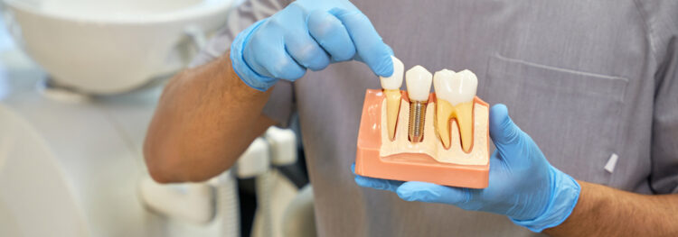 Dental Implants for Cosmetic Reasons: Beyond Tooth Replacement