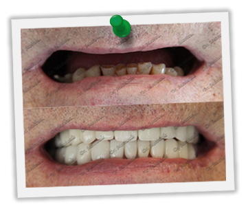 Dental implants before & after