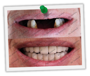Dental implants before & after