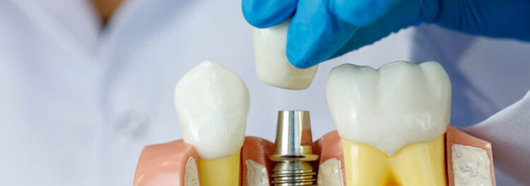 Future Trends: Implants Without Bone Grafts