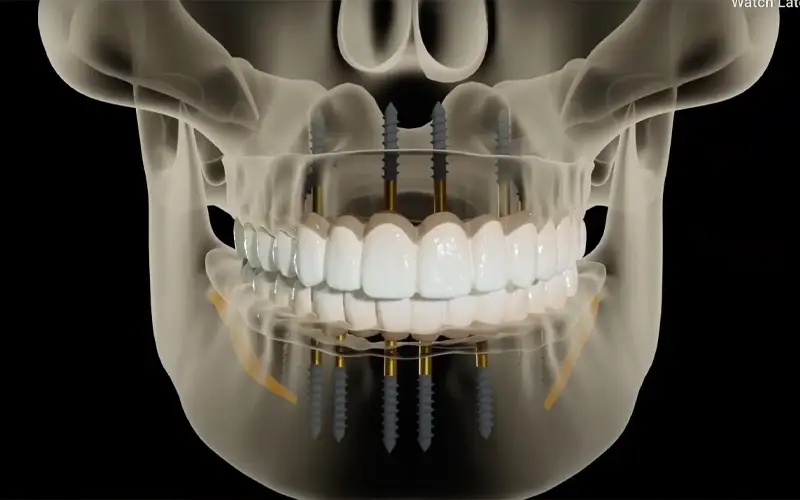 Read more about the article All-on-6 vs All-on-8 Dental Implants: Biomechanical Differences