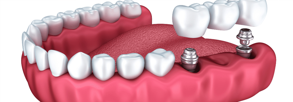A Break Down of Cost of Implants in India vs. the West