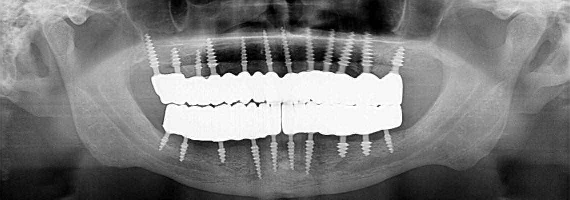 Read more about the article Why 80% of Patients Regret Not Switching Sooner to Basal Implants