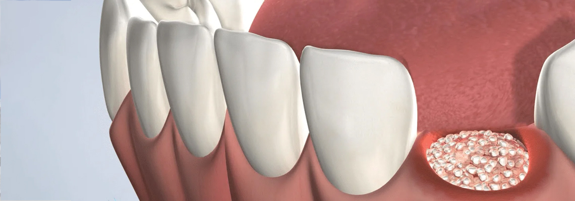 Read more about the article Bone Graft Conspiracy: Why is an Outdated Procedure Kept Alive?