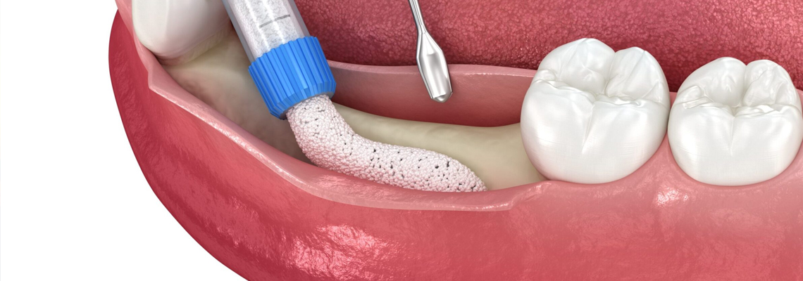 Europe Abandoned Bone Grafts Years Ago: Why America is Behind