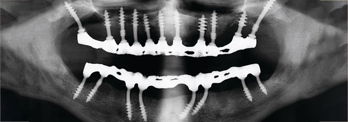Read more about the article Why 80% of Patients Regret Not Switching Sooner to Basal Implants