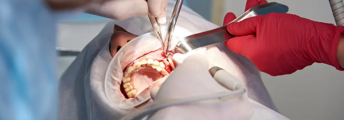 I Chose the Wrong Implants: One Patient's Sinus Lift Horror Story