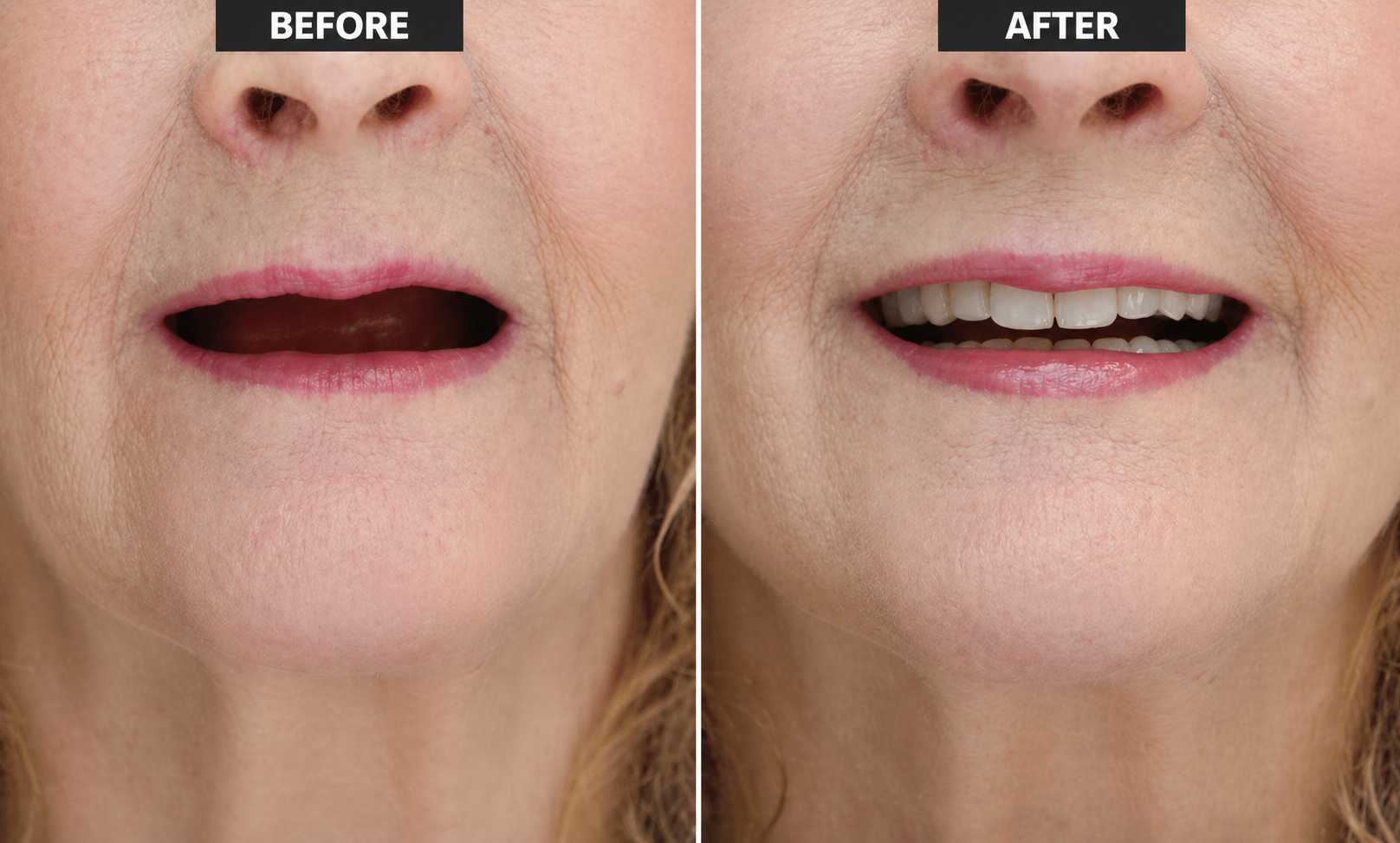 Why Americans Choose India for Full Mouth Dental Implants Abroad