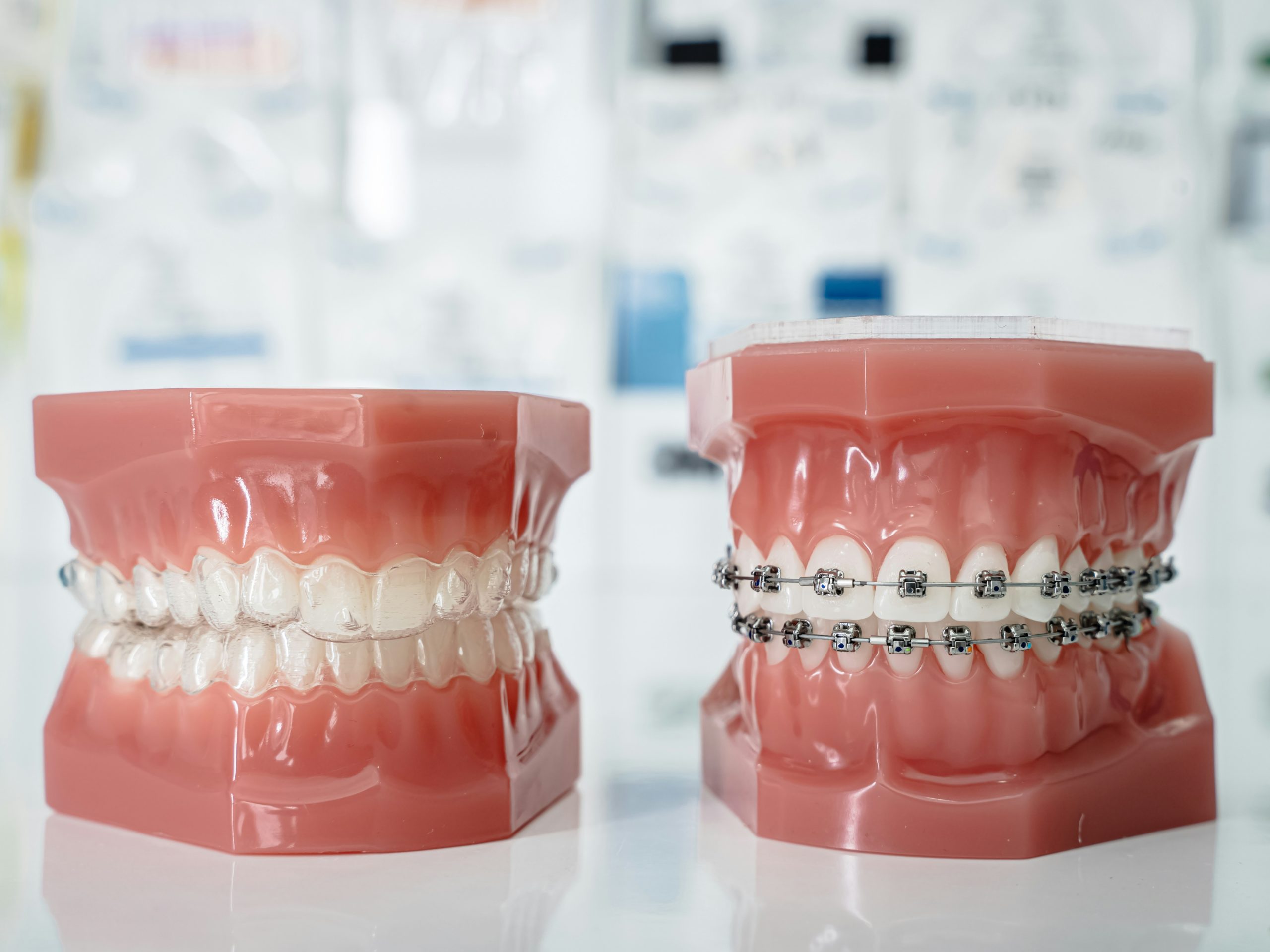 clear aligners vs braces Hyderabad